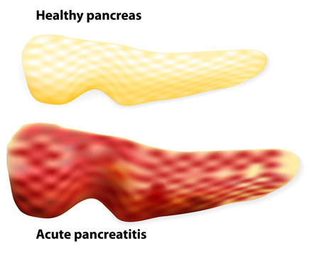 Pancreatitis. The differences between healthy pancreas and infla