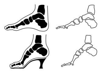 Podologe - Fuß - Stellung normal & High Heels