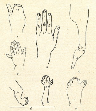 Finger anomalies