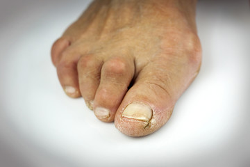Cracked toe on white background