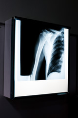 X-ray of shoulder