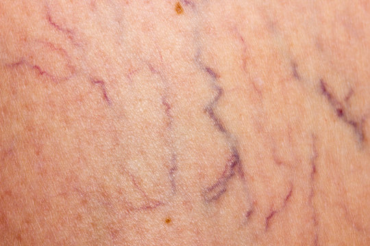 Affected by varicose veins