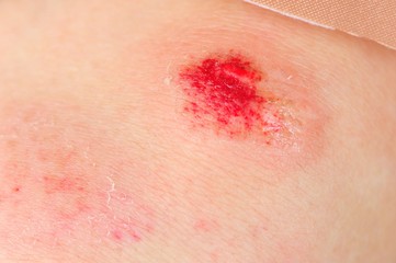 skateboard injured knee