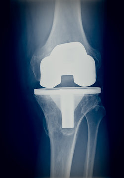 Bicompartmental knee prosthesis xray