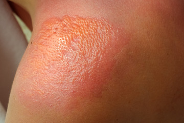 Close up detail of a very bad sunburn