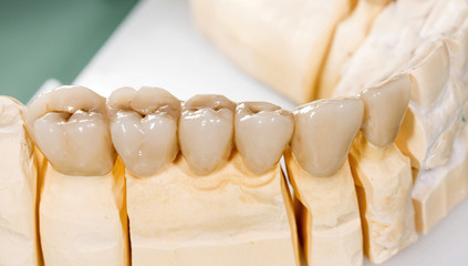 Dental ceramic bridge