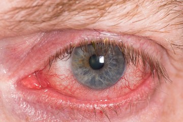 Almost open red and irritated eye with blood vessels