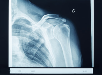 X-ray shoulder