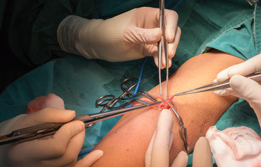 arteriovenous fistula operation