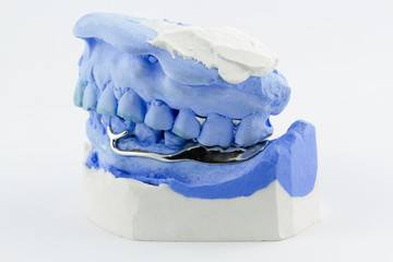 Dental wire bending for make a partial denture
