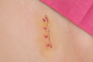 Closeup of fresh appendix surgery scar, appendectomy