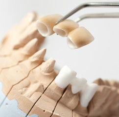Fototapeta na wymiar Dental prothetic