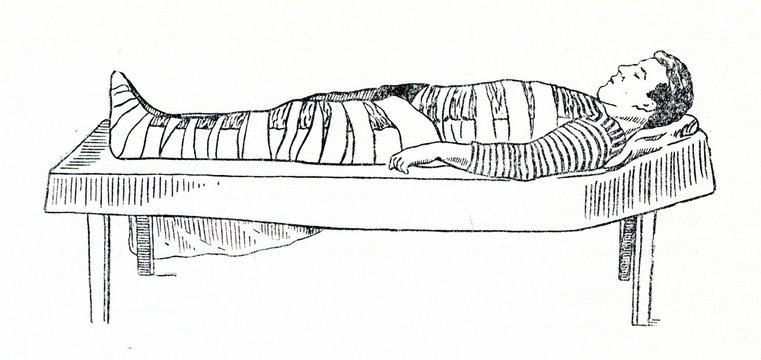 Emergency splinting of thigh fracture