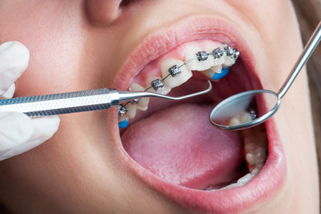 Extreme close up of human mouth with braces.