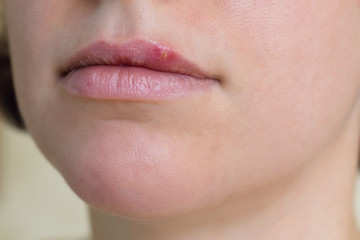 Herpes virus on female lips