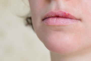 Herpes virus on female lips