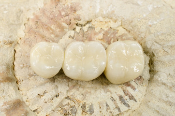 Seitenzahnbrücke auf Fossil