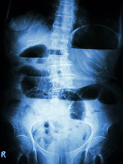 Small bowel obstruction. X-ray abdomen: small bowel dilated