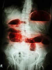 Small bowel obstruction. X-ray abdomen: small bowel dilated