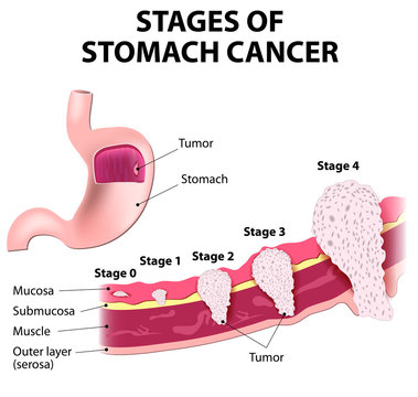 Staging of stomach cancer