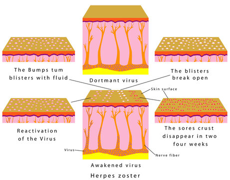 Herpes Zoster