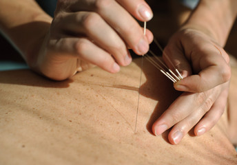 Acupuncture.Chinese medicine treatmen