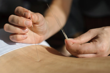 Acupuncture.Chinese medicine treatmen