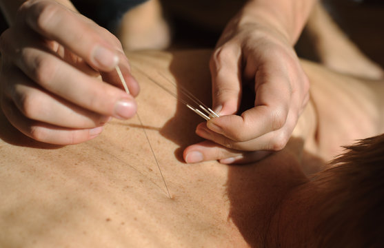 Acupuncture.Chinese medicine treatmen