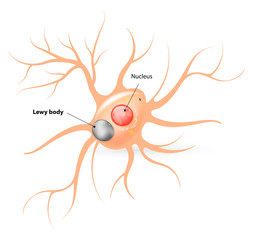 Lewy body. Parkinson's disease and Alzheimer's disease