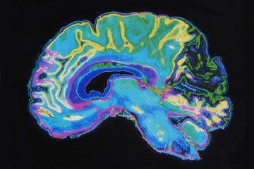 MRI Image Brain On Black Background