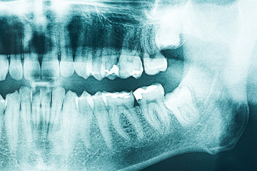 Panoramic Dental X-Ray Of Human Teeth