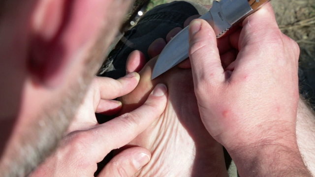 man removong splint from his foot with a knife