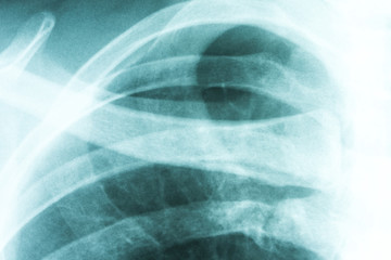 Medical X-Ray Of Human Collar Bone