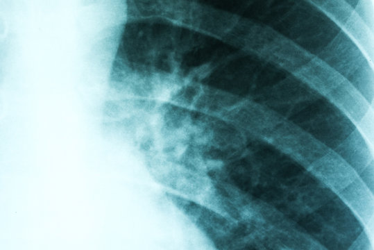 Medical X-Ray Of Pneumonia Infected Lungs