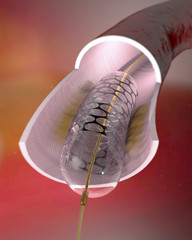 Sezione di un'arteria con stent inserito. Inserimento chirurgico
