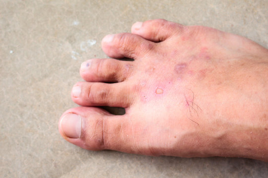 closeup skin athlete’s foot psoriasis fungus, hong kong foot,