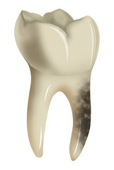 Decayed tooth isolated on white background