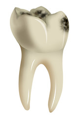 Tooth with caries isolated on white