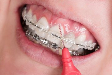 Zahnreinigung bei Zahnspange
