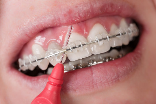 Zahnklammer und Dentalb&uuml;rste