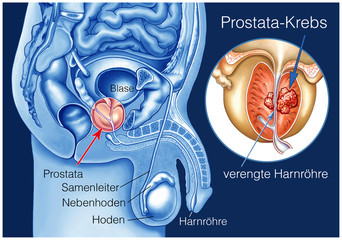Prostata-Krebs.Tumor