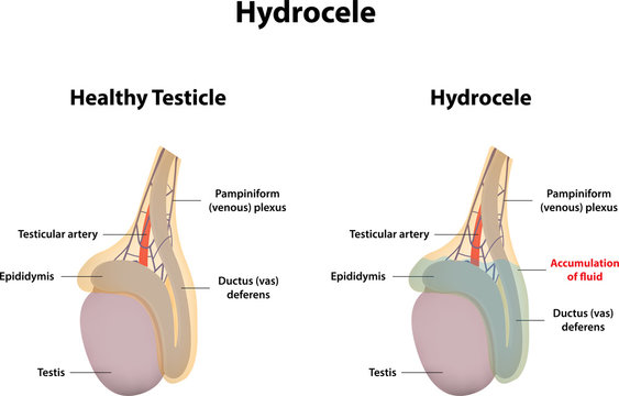 Hydrocele