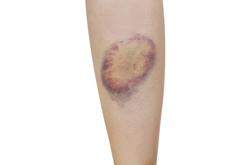 isolated bruise leg in white background