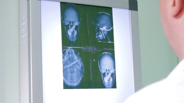 Doctor examines an X-ray of the brainpan
