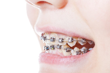 dental steel braces on teeth close up © vvoe