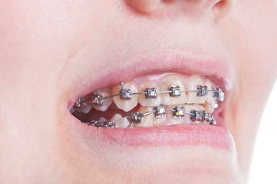 Orthodontic Braces On Teeth Close Up