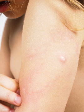 Child with hive, rash, or some skin abnormality