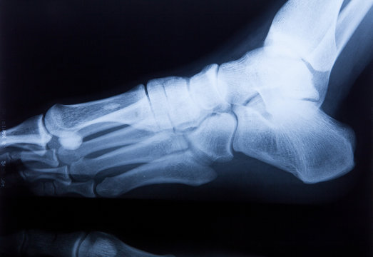 Ankle feet & knee joint X-ray human photo film..