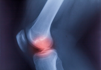 Ankle feet & knee joint X-ray human photo film..