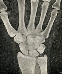 Wrist X-ray radiograph